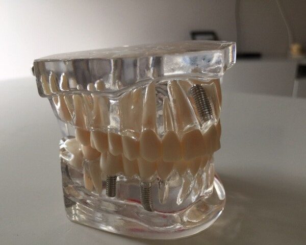 Przezroczysty model zębów / szczęki