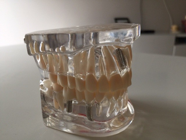 Przezroczysty model zębów / szczęki