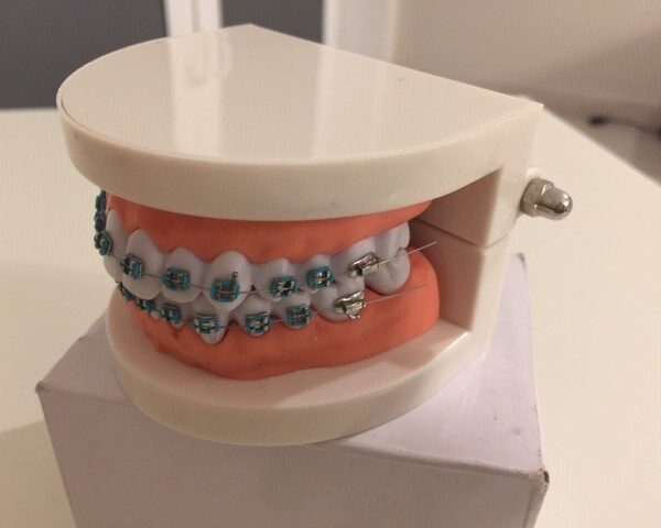 Model szczęki z aparatem ortodontycznym. Idealny do edukacji pacjentów, szkoleń stomatologicznych i prezentacji działania aparatów ortodontycznych.