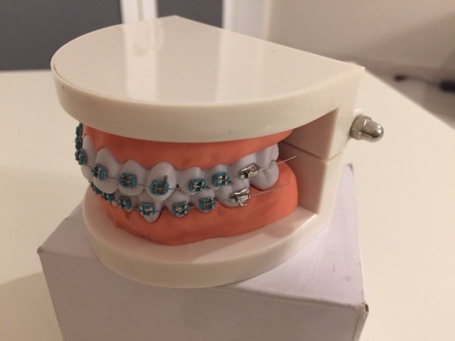 Model szczęki z aparatem ortodontycznym. Idealny do edukacji pacjentów, szkoleń stomatologicznych i prezentacji działania aparatów ortodontycznych.