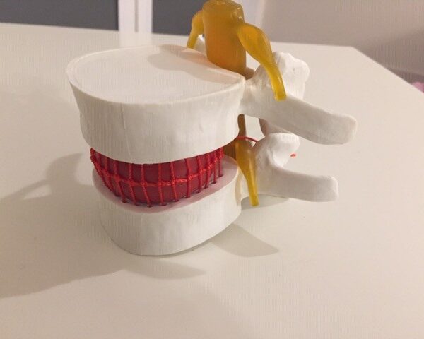 Symulacja wypadnięcia jądra galaretowatego